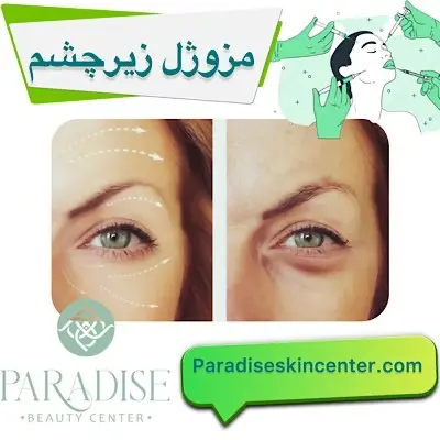 مزوژل زیرچشم