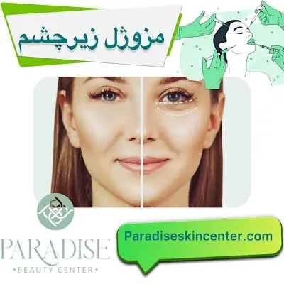 مزوژل زیرچشم