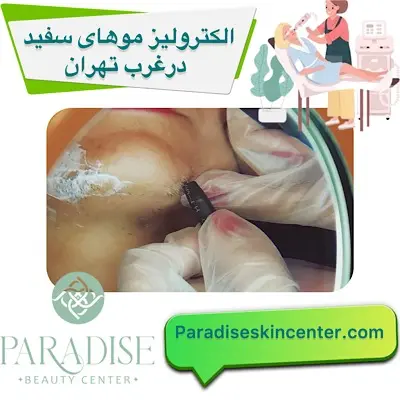 الکترولیز موهای سفید در غرب تهران