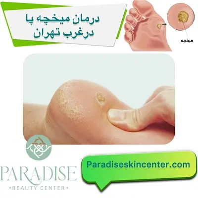 درمان میخچه پا در غرب تهران