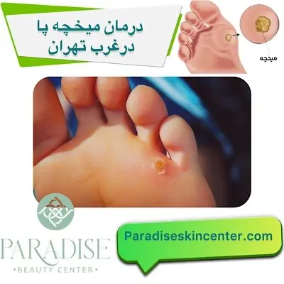 درمان میخچه پا در غرب تهران