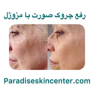 رفع چروک صورت با مزوژل
