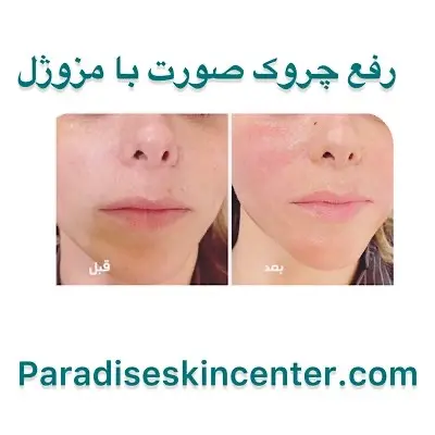 رفع چروک صورت با مزوژل