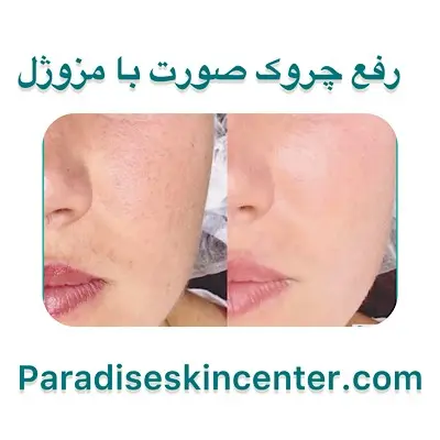 رفع چروک صورت با مزوژل