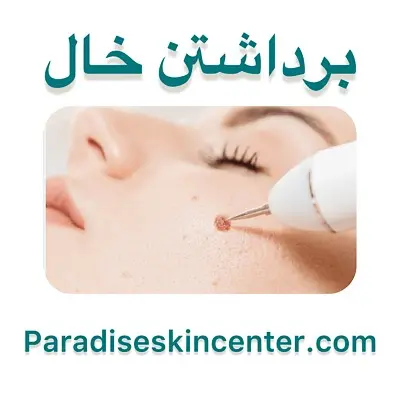 برداشتن خال