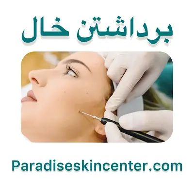 برداشتن خال