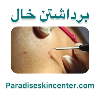 برداشتن خال