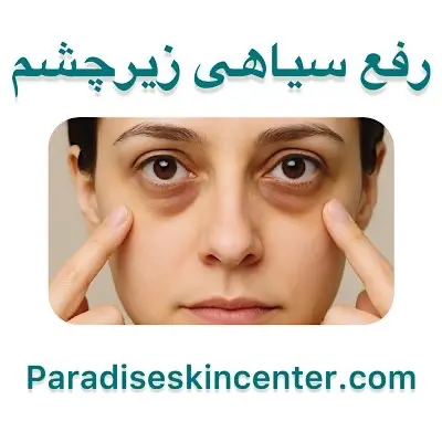 رفع سیاهی زیر چشم