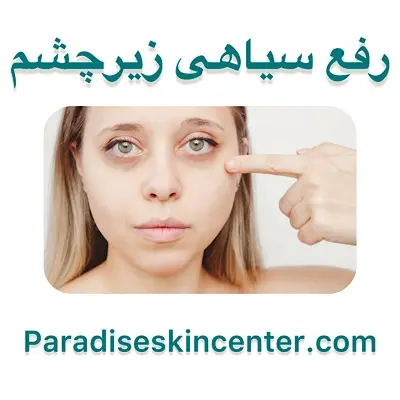 رفع سیاهی زیر چشم