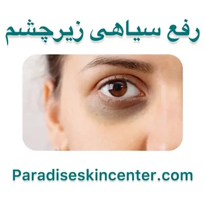 رفع سیاهی زیر چشم