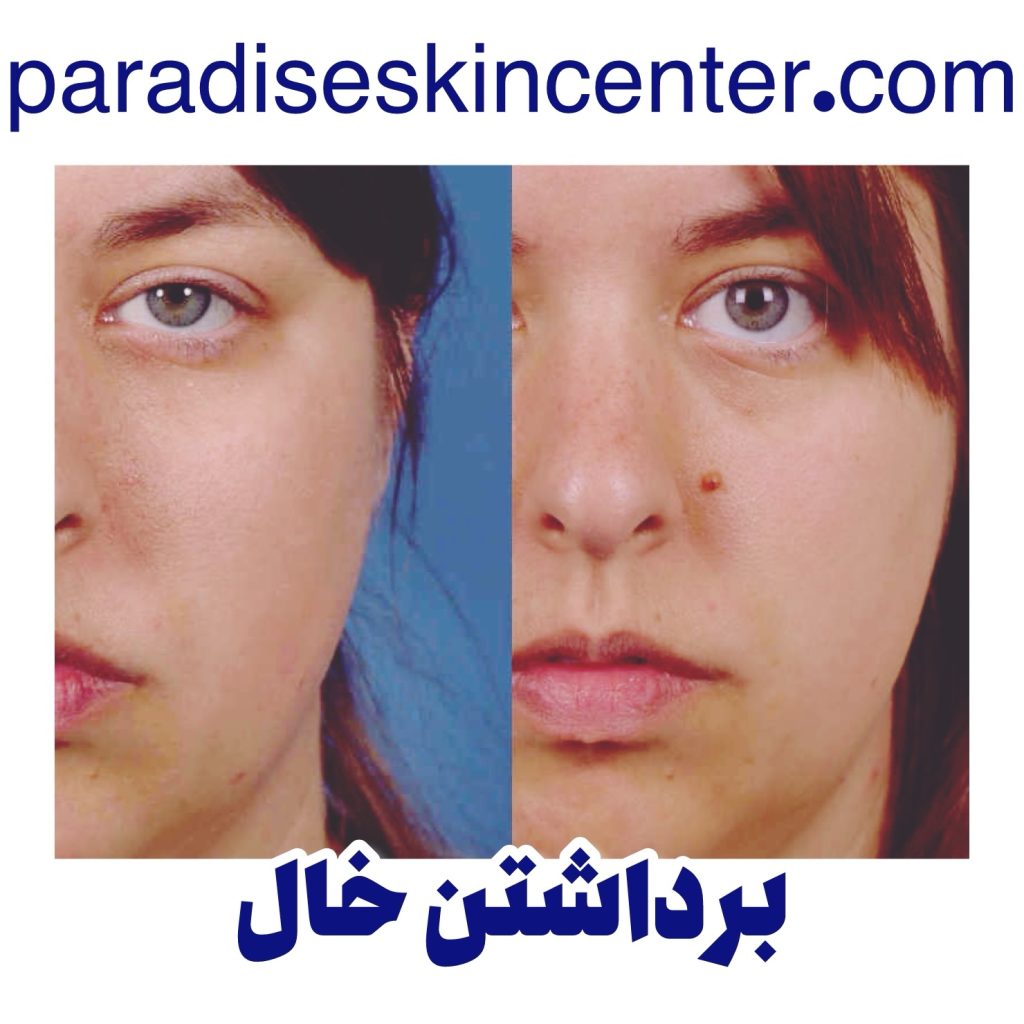 برداشتن خال