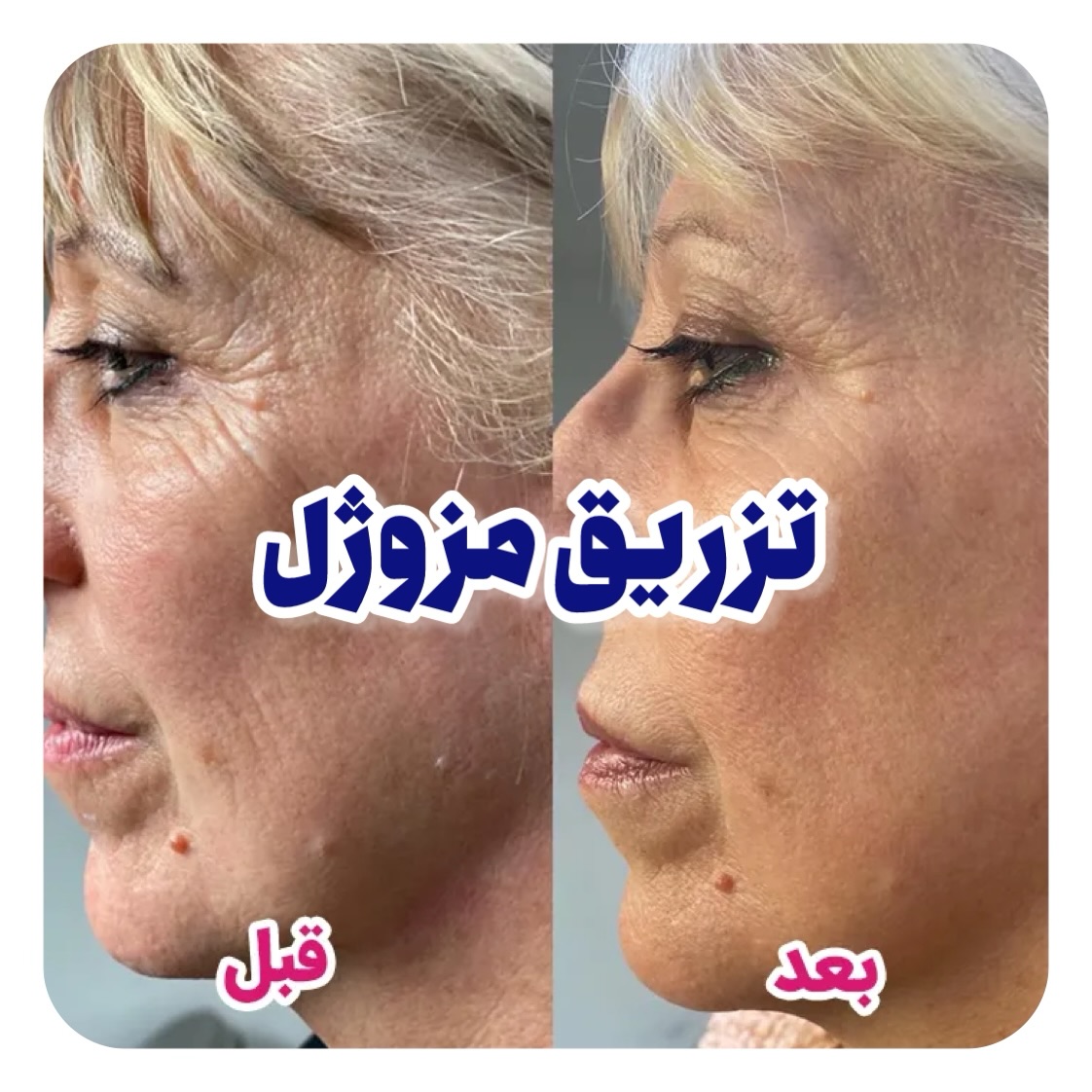 رفع چروک صورت با مزوژل