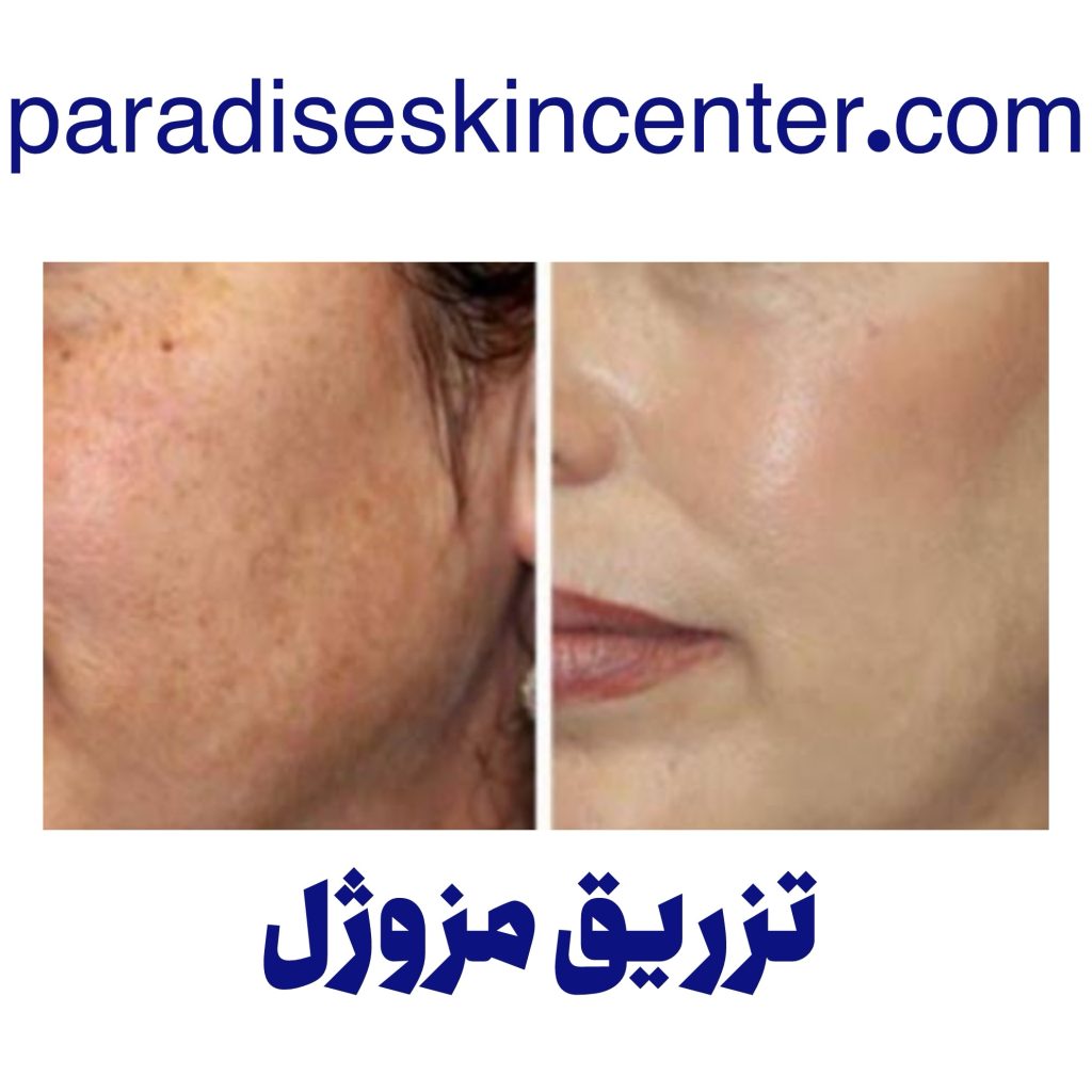 رفع چروک صورت با مزوژل