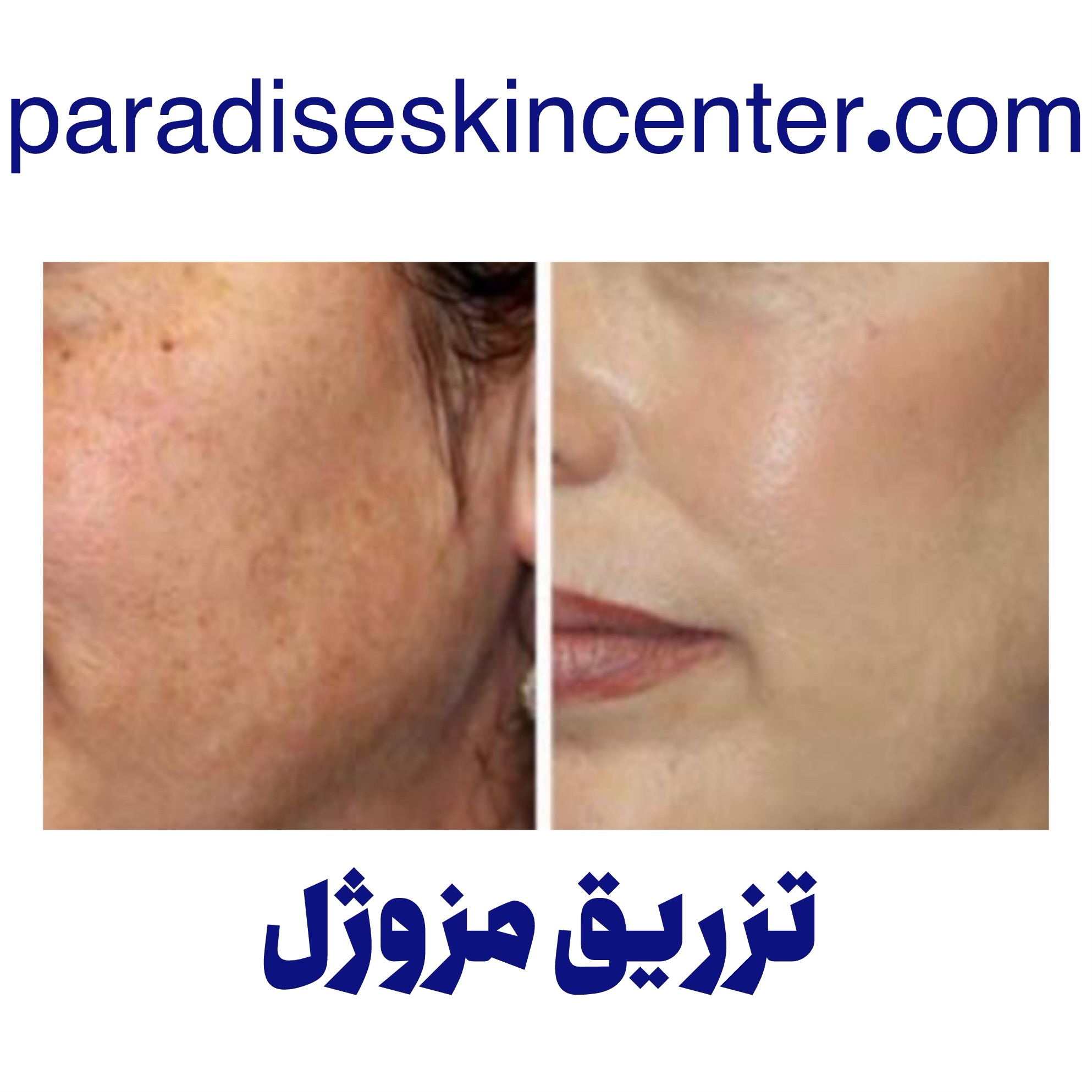 رفع چروک صورت با مزوژل