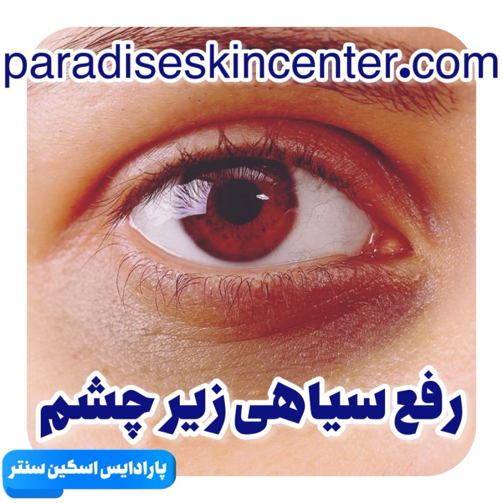 رفع سیاهی زیر چشم