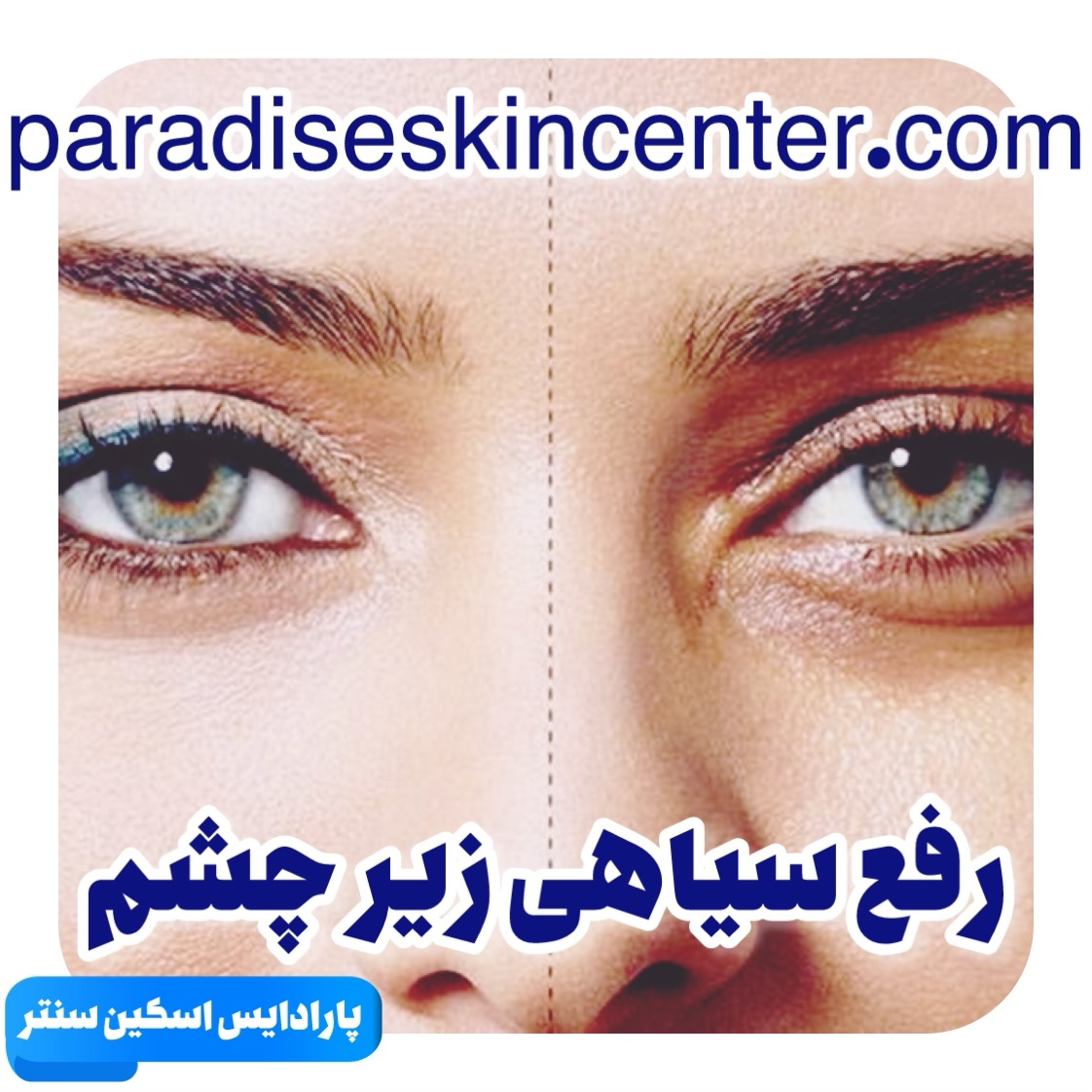 رفع سیاهی زیر چشم