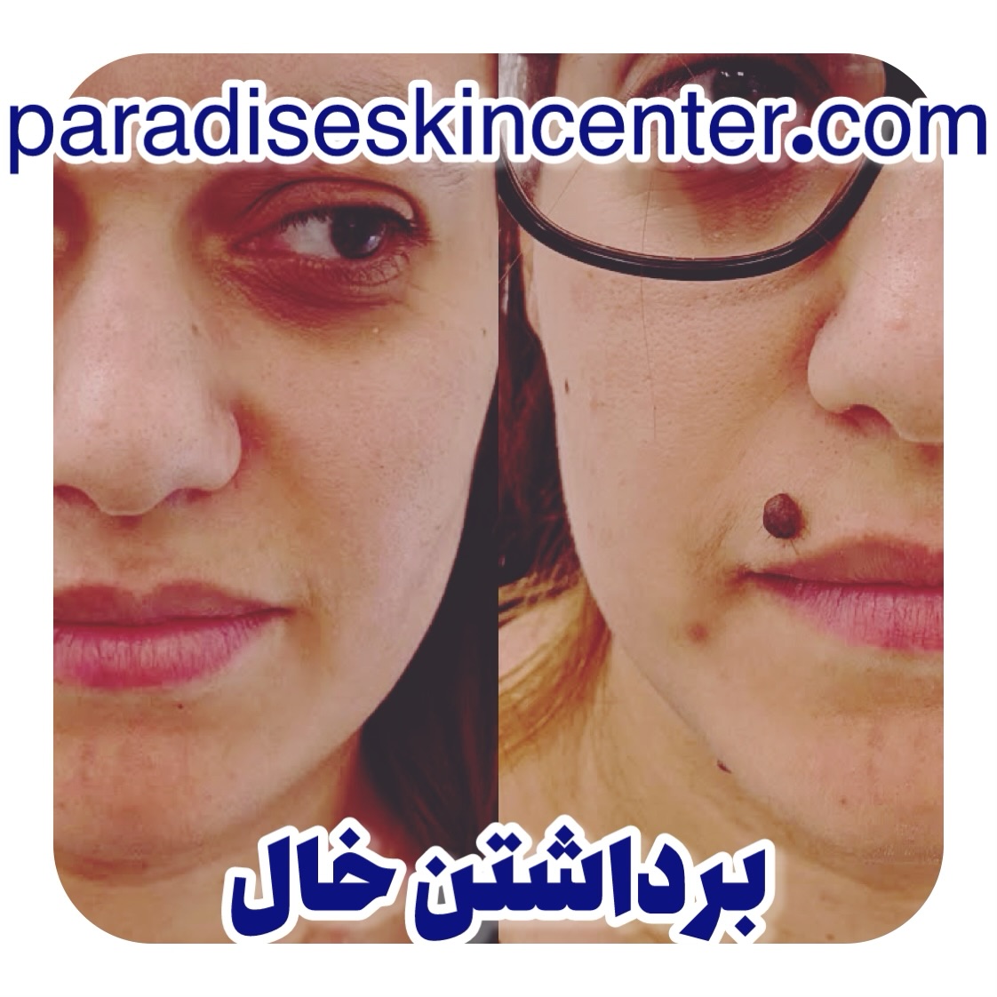 برداشتن خال