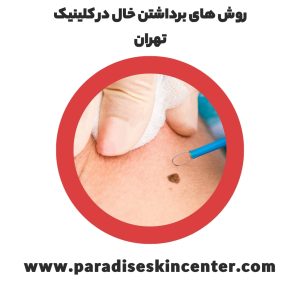 روش های برداشتن خال در کلینیک تهران