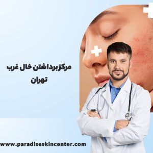 مرکز برداشتن خال غرب تهران