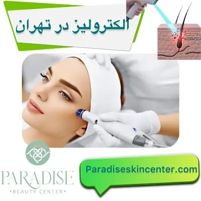 الکترولیز در تهران