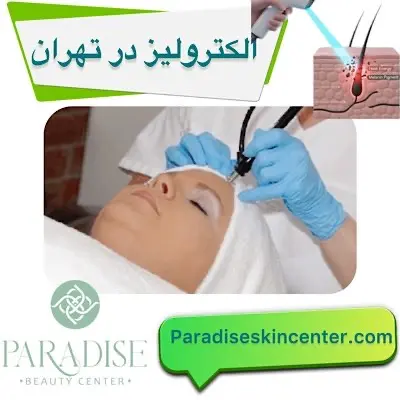 الکترولیز در تهران