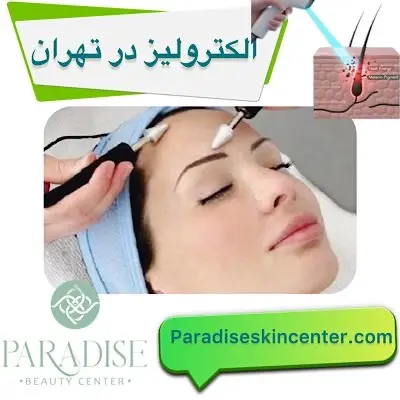 الکترولیز در تهران