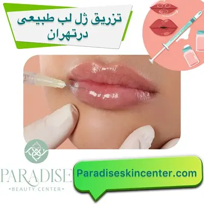 تزریق ژل لب طبیعی در تهران