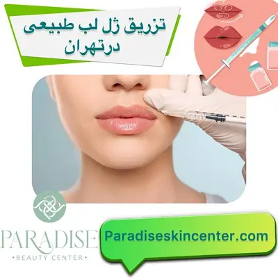 تزریق ژل لب طبیعی در تهران