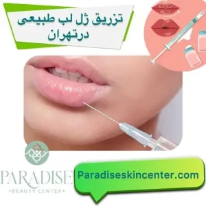 تزریق ژل لب طبیعی در تهران