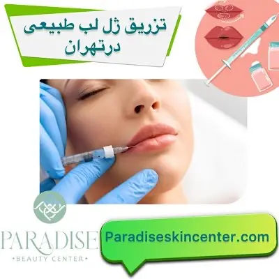 تزریق ژل لب طبیعی در تهران