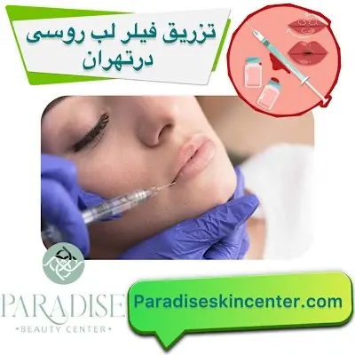 تزریق فیلر لب روسی در تهران
