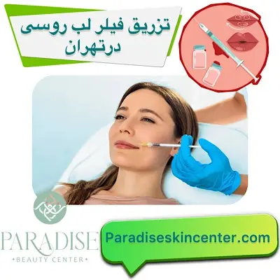 تزریق فیلر لب روسی در تهران