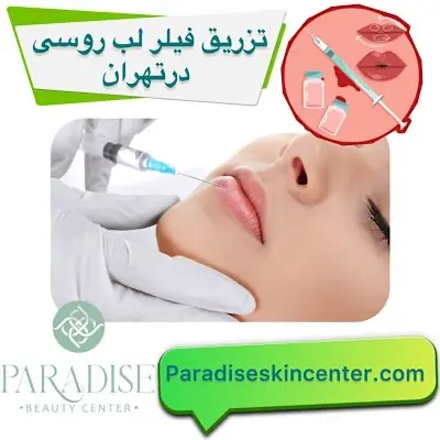 تزریق فیلر لب روسی در تهران