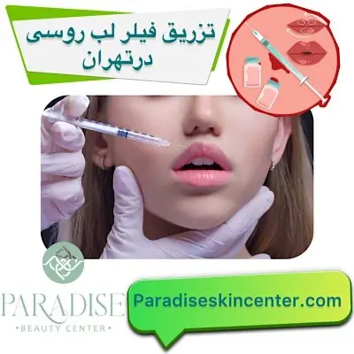 تزریق فیلر لب روسی در تهران