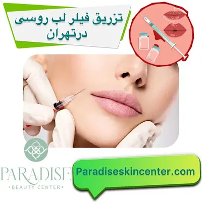 تزریق فیلر لب روسی در تهران