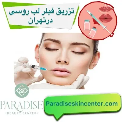 تزریق فیلر لب روسی در تهران