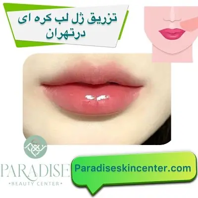 تزریق ژل لب کره ای در تهران