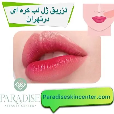 تزریق ژل لب کره ای در تهران